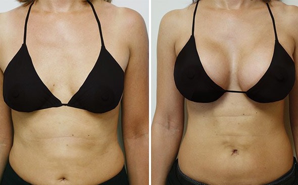 Breast augmentation improves the size and shape of breasts by fitting breas...